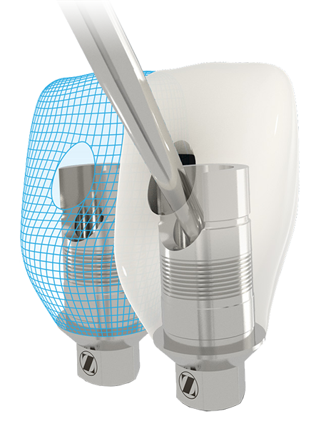 TSV® BellaTek® Express and Flex Abutments